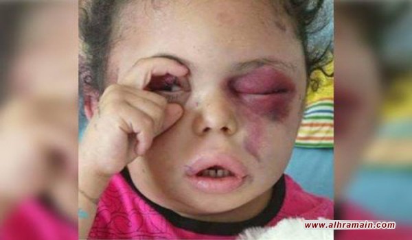 وَضع التّحالف العَربي على القائمة الأُمميّة السّوداء لمُرتكبي الجرائم ضِد الأطفال في اليَمن ضَربةٌ دبلوماسيّةٌ &ldquo;مُحرجة&rdquo;.. 